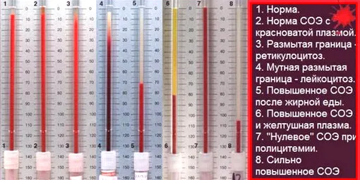 Почему СОЭ повышенное и нужно ли это лечить — Лайфхакер