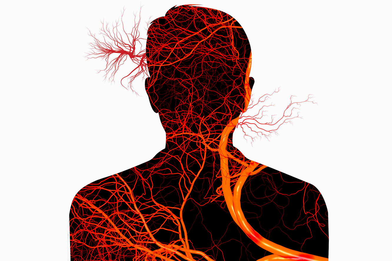 Атеросклероз сосудов шеи и головы. Сосуды изображение.