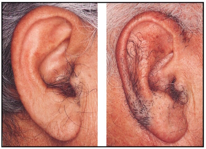 Грибковые заболевания ушей