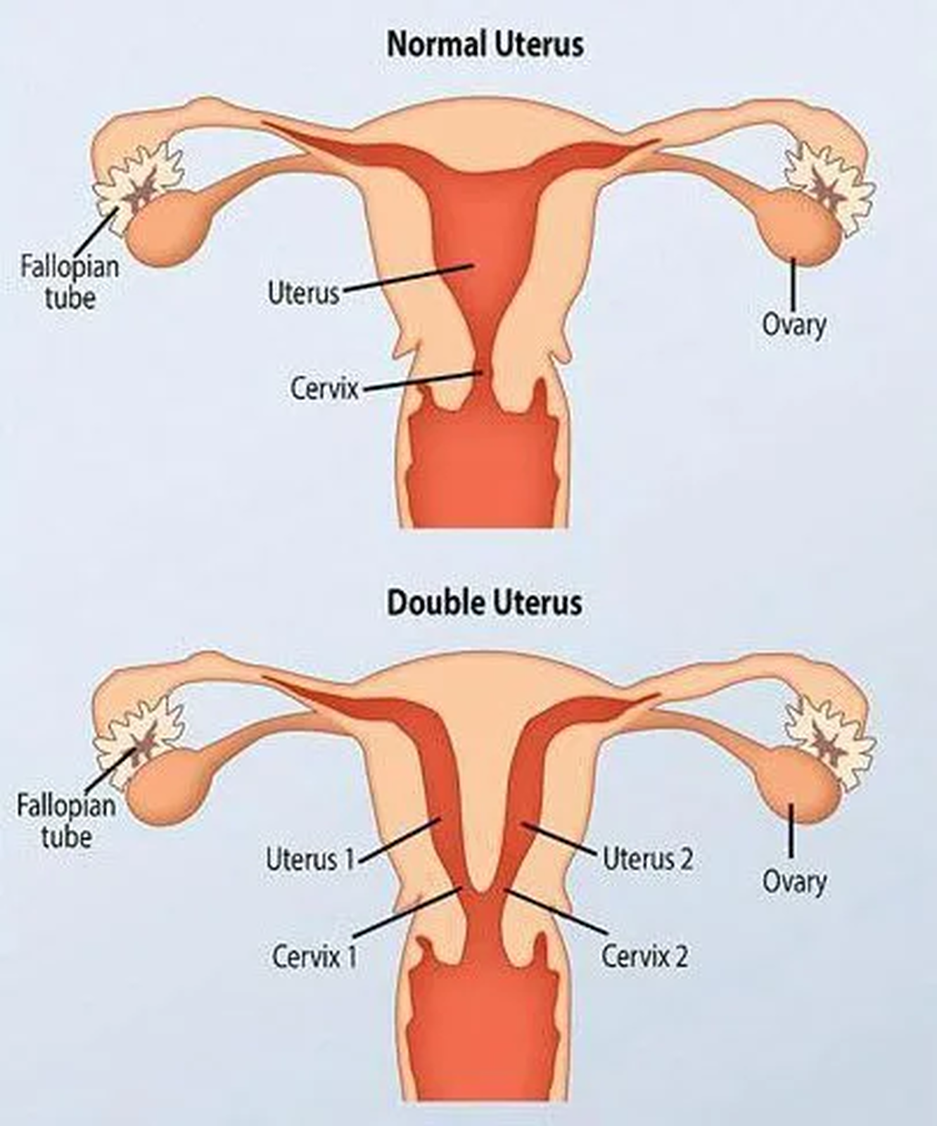 В США девушка с двумя матками забеременела двойней