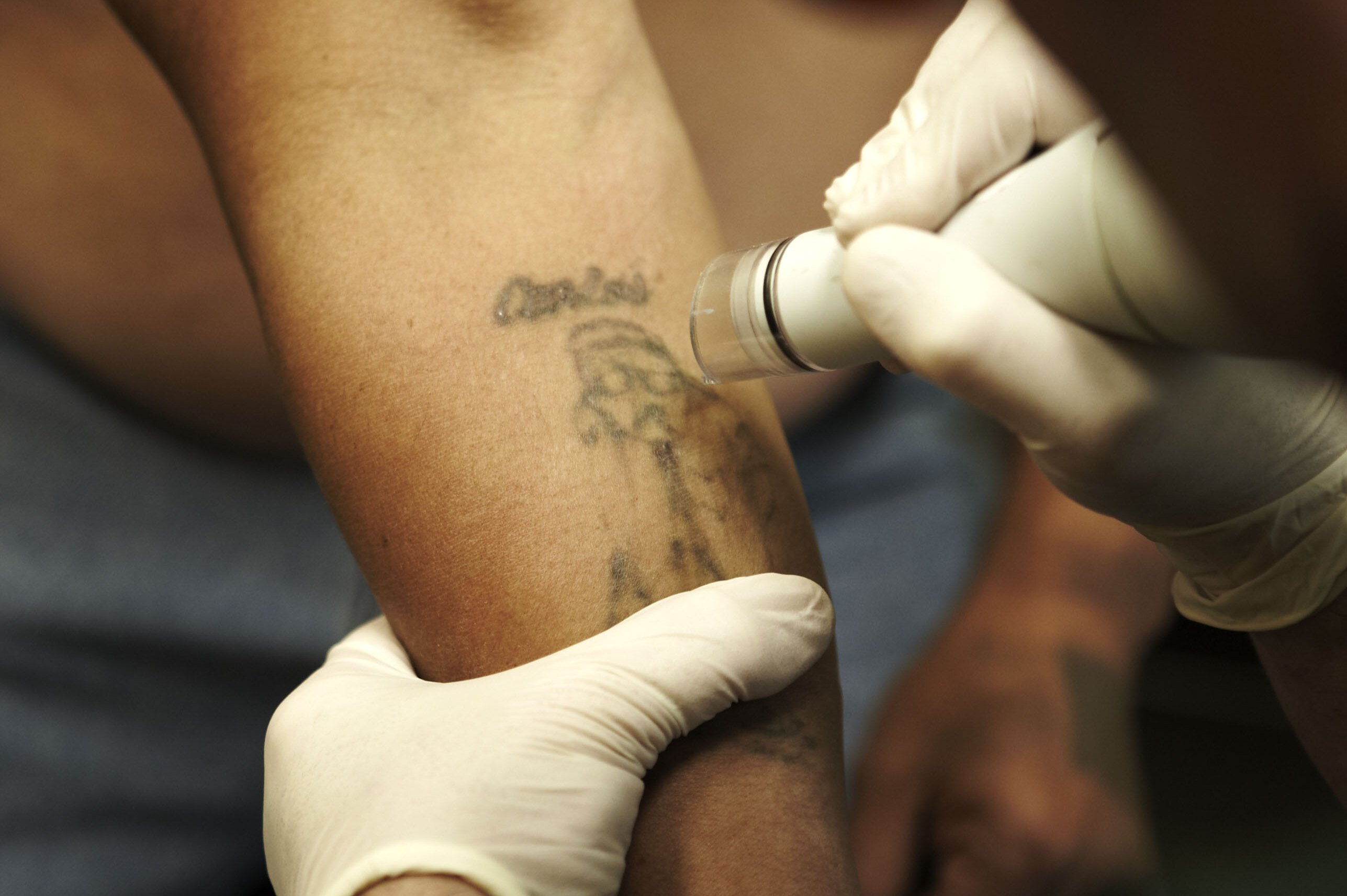 Чем опасны татуировки? Мнения врачей | Evolutis Clinic | Дзен