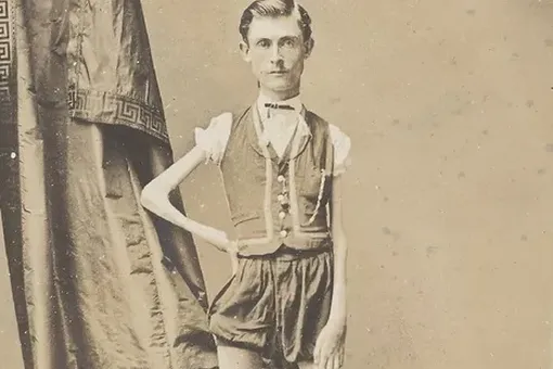 «Живой скелет»: трагичная история американца, который весил меньше 20 кг и стал цирковым уродом