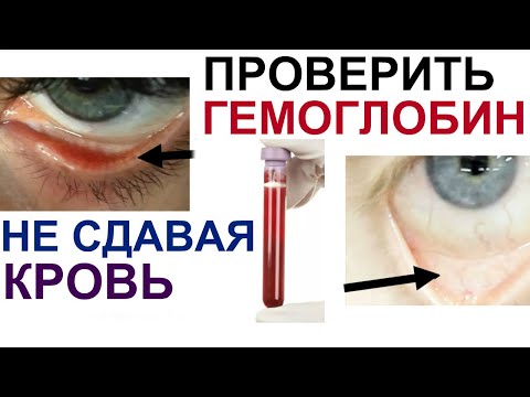 Низкий гемоглобин(анемия) - Кировский центр крови